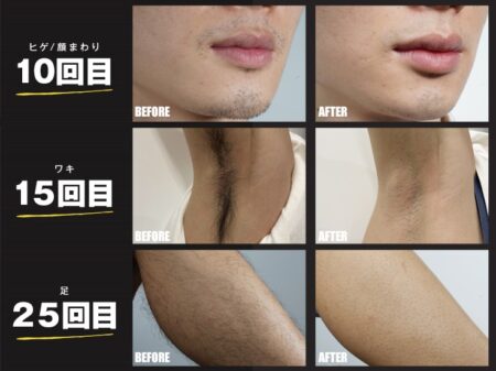jovs脱毛器　ビフォーアフター　男性